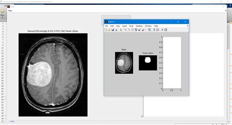 Brain Tumor Detection Using Matlab Code Alsfar