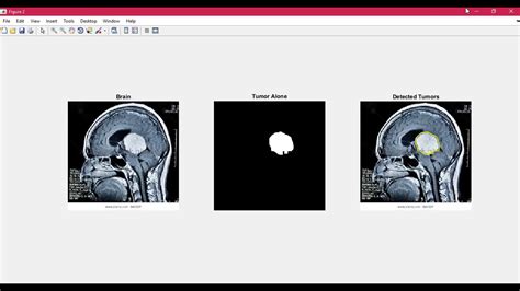 Read Online Brain Tumor Detection Using Matlab Code Alsfar 