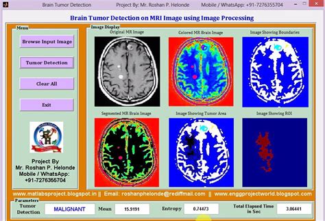 Download Brain Tumor Detection Using Matlab Code Alsfar 