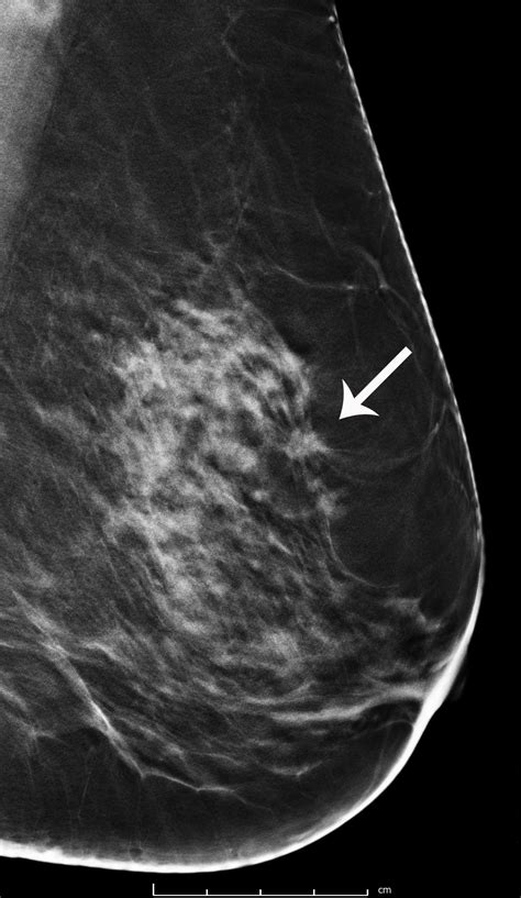 Read Breast Cancer Imaging 