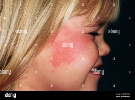 brennender roter ausschlag