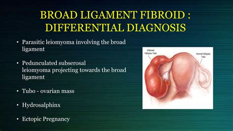 Broad Ligament Fibroid