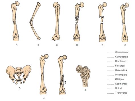 Broken Bone Bone Fracture Worksheet - Bone Fracture Worksheet