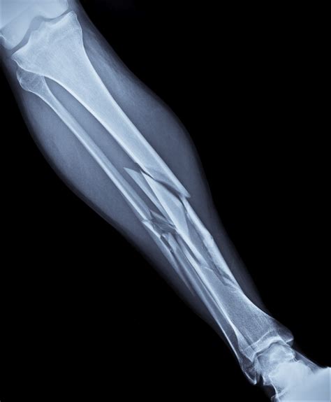 Broken Bone Injur Broken Bone Injury Lawyer 256 Types Of Bone Fractures Worksheet - Types Of Bone Fractures Worksheet