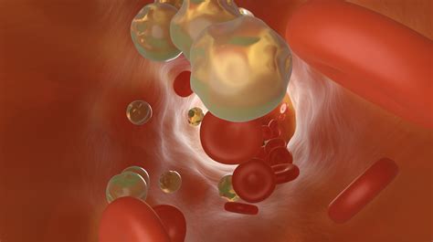 bromsa aderforkalkning