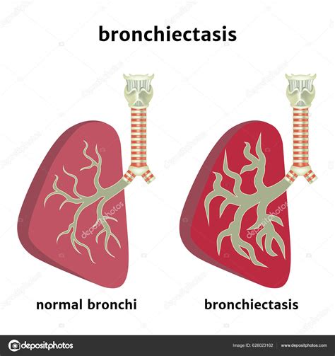 bronchiectasie