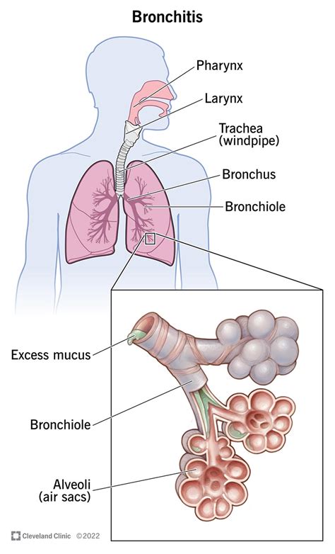 bronchitis