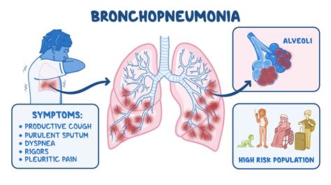 bronkopneumonia
