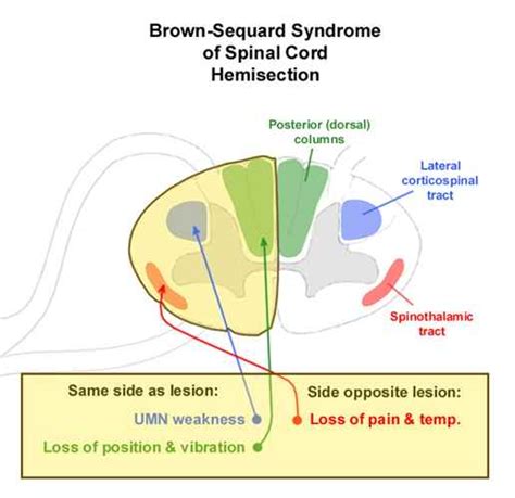 Brown Sequard Disease