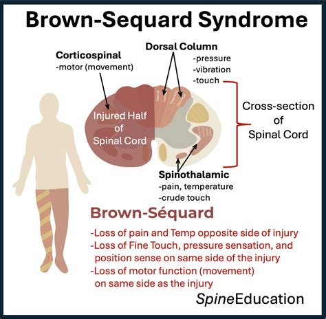 Brown Sequard Syndrome