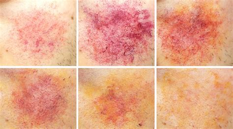 bruise coloring