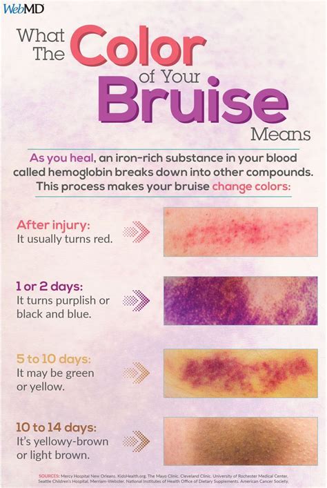 bruises can be accurately dated or aged based on color?