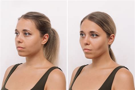 buccal fat removal? is it worth it? : r/TheGlowUp