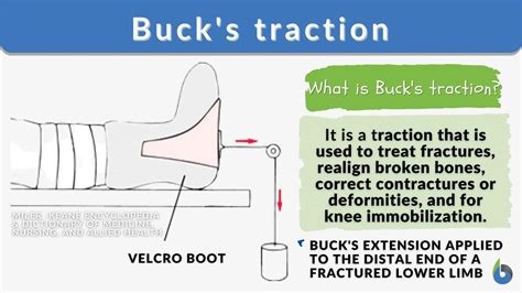 Buck Traction Hob Elevation