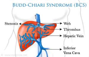 Budd Chiari Sendromu