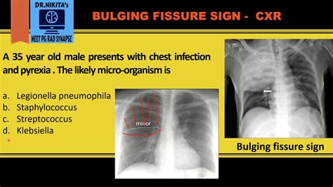 Bulging Fissure Sign