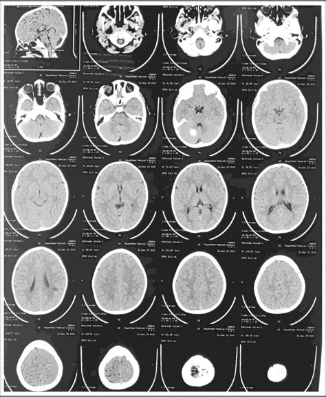 Bullet In The Brain Analysis