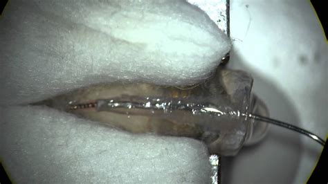 Bur And Lund Image