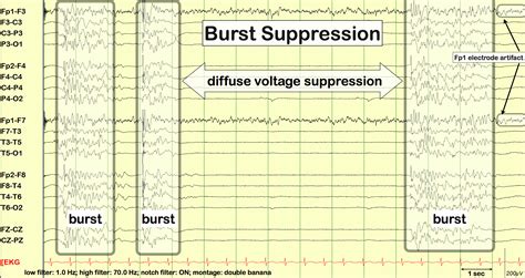 burst suppression