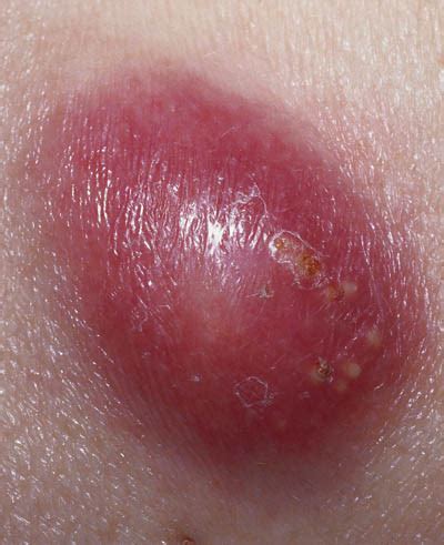 byller i underlivet behandling