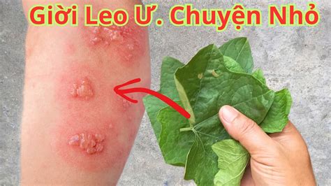 cách trị giời leo | Cch tr bnh gii leo dn gian