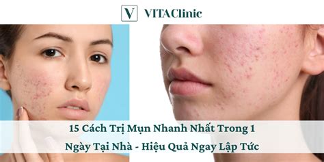 cách trị mụn | 20 Cch Tr Mn Ti Nh An