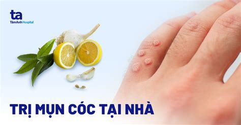 cách trị mụn cóc | 13 cch tr mn cc hiu qu