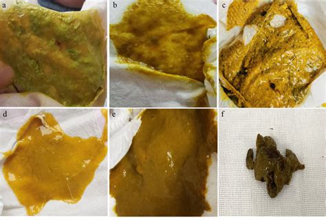 c diff poop color