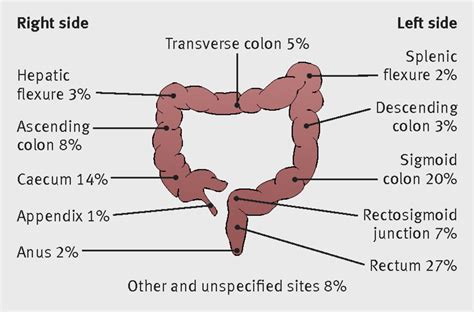 Ca Colon Adalah