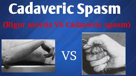Cadaveric Spasm