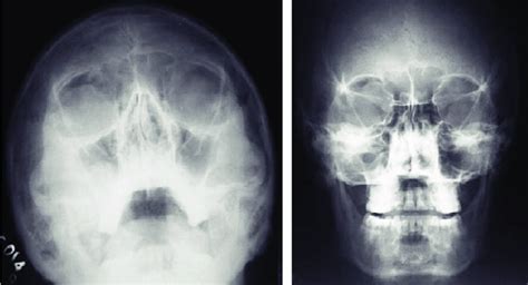 Caldwell View Vs Waters View