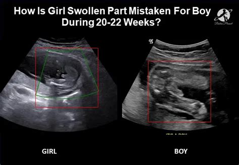 can a girl be mistaken for a boy at 18 weeks