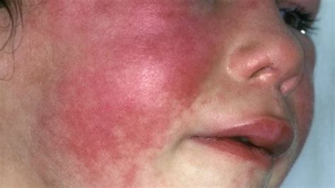 can adults get scarlet fever