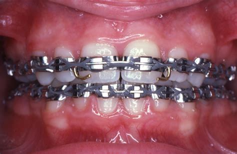 can braces cause cancer naturally