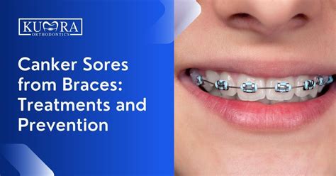 can braces cause canker sores