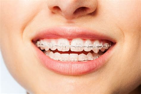 can braces cause tooth pain
