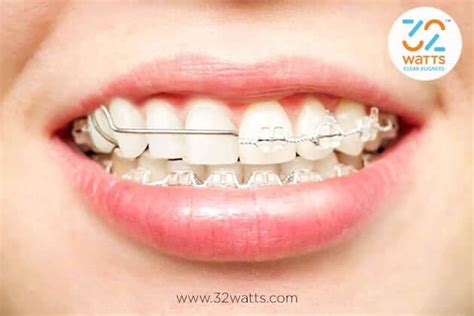 can braces cause tooth pain