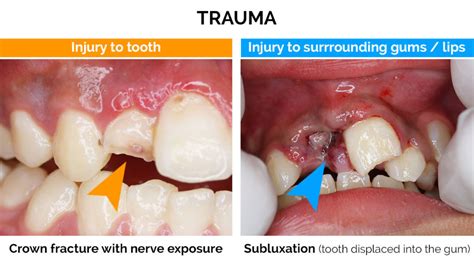 can braces cause tooth trauma pictures