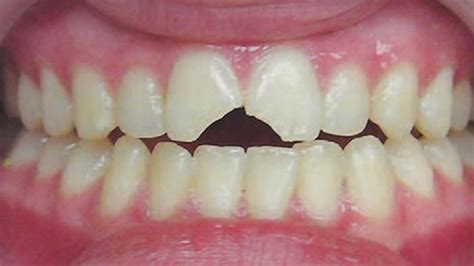 can braces cause tooth trauma treatment
