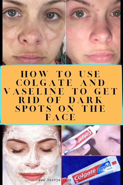 can colgate remove dark spots on face