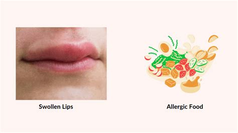can food allergies cause lips to swell back