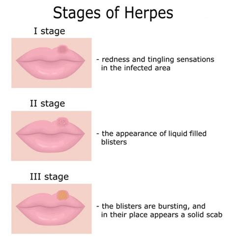 can i kiss someone with hsv 2