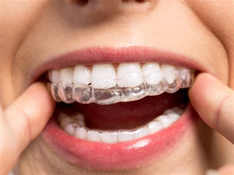 can invisalign braces damage teeth naturally