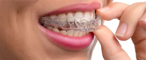 can invisalign braces damage teeth video