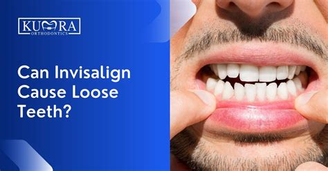can invisalign cause tooth decay