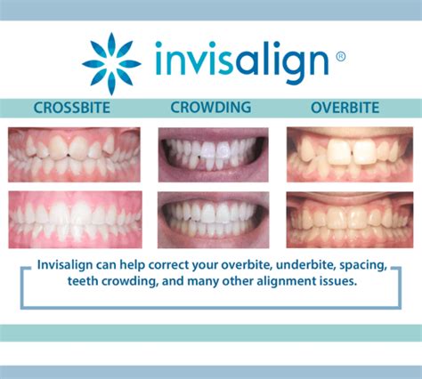 can invisalign do what braces do