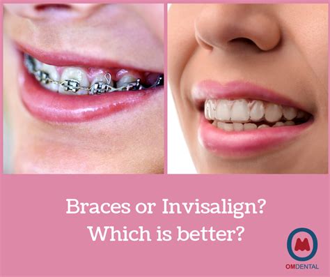 can invisalign do what braces download