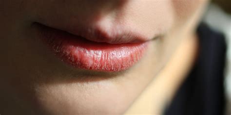 can kissing cause chapped lips