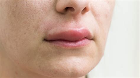 can kissing cause lip swelling