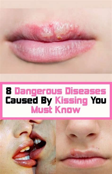 can kissing make you feel sick symptoms
